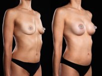 Before and after breast augmentation results at Vidnova Clinic – enhanced breast shape