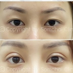 نتائج رأب الجفن قبل وبعد في عيادة سومشاي، تحسين تصحيح الجفون