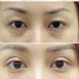 نتائج رأب الجفن قبل وبعد في عيادة سومشاي، تحسين تصحيح الجفون