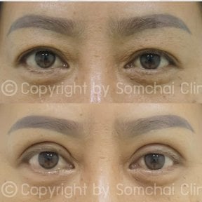 نتائج رأب الجفن قبل وبعد في عيادة سومشاي، تصحيح الجفون لمظهر شاب