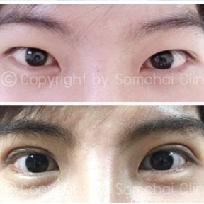 نتائج رأب الجفن قبل وبعد في عيادة سومشاي – تحسين شكل الجفون