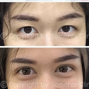 نتائج رأب الجفن قبل وبعد في عيادة سومشاي، تحسين تصحيح الجفون