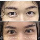 نتائج رأب الجفن قبل وبعد في عيادة سومشاي، تحسين تصحيح الجفون