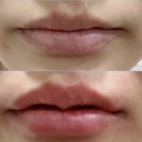 Before and after lip fillers injection result at Somchai Clinic, enhanced lip volume