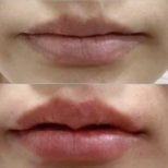 Before and after lip fillers injection result at Somchai Clinic, enhanced lip volume