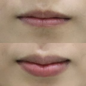 Before and after lip fillers injection result at Somchai Clinic, enhanced lip volume and shape
