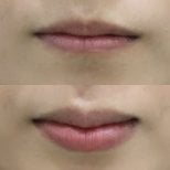 Before and after lip fillers injection result at Somchai Clinic, enhanced lip volume and shape