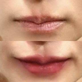 Before and after lip fillers injection result at Somchai Clinic, enhanced lip volume and shape