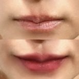 Before and after lip fillers injection result at Somchai Clinic, enhanced lip volume and shape
