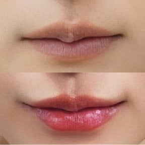 Before and after lip fillers injection result at Somchai Clinic, enhanced lip volume and shape