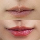 Before and after lip fillers injection result at Somchai Clinic, enhanced lip volume and shape