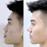 Результат ринопластики до и после в клинике Somchai, улучшенный профиль носа мужчины