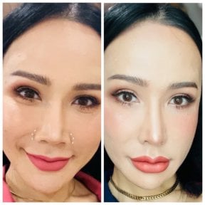 Before and after rhinoplasty results at Somchai Clinic, nose reshaping with natural look