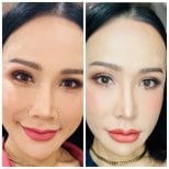 Before and after rhinoplasty results at Somchai Clinic, nose reshaping with natural look