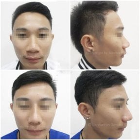 Vorher-nachher-Rhinoplastik-Ergebnisse in der Somchai Clinic, verbesserte Nasenform