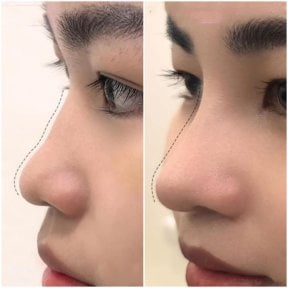 Vorher-nachher-Rhinoplastik-Ergebnisse in der Somchai Clinic, verbesserte Nasenkontur