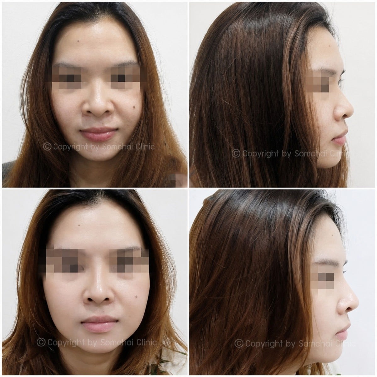 نتائج تجميل الأنف قبل وبعد في عيادة سومشاي، إعادة تشكيل الأنف بمظهر طبيعي