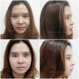 Vorher-nachher-Ergebnis der Nasenkorrektur in der Somchai Clinic, natürliche Nasenform