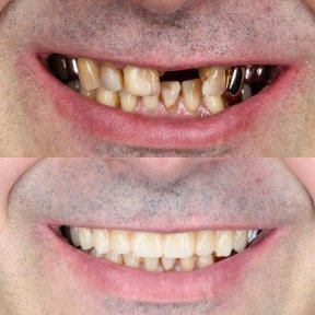 Vorher-nachher-Ergebnis All-on-4-Implantate bei Dental Clinic Dynasty Stomatology Prag