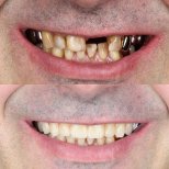 Vorher-nachher-Ergebnis All-on-4-Implantate bei Dental Clinic Dynasty Stomatology Prag