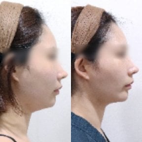 Ultherapy Vorher-Nachher-Ergebnis bei Lalian Cheongdam Clinic – straffere Kinnlinie