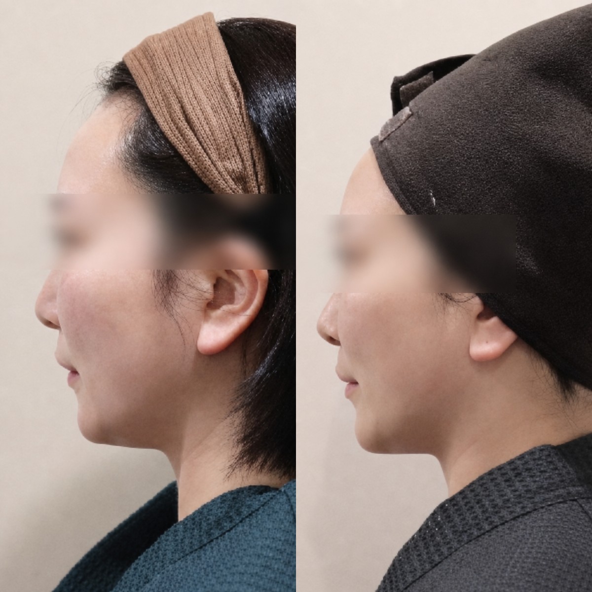 Resultados antes y después de Thermage en Lalian Cheongdam Clinic, mejora del contorno facial