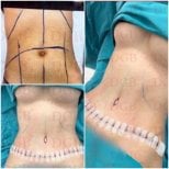 Before and after tummy tuck and liposuction results at DGB Clinic, improved abdominal contour