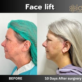 before-after photo mini-facelift