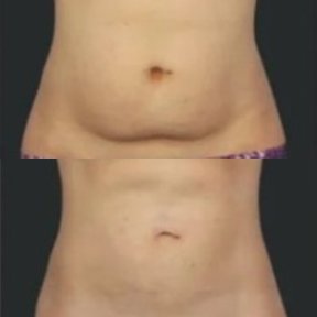 Результати кріоліполізу до і після в Alpha Beauty Hannover, помітне зменшення жиру на животі