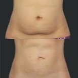 Результати кріоліполізу до і після в Alpha Beauty Hannover, помітне зменшення жиру на животі