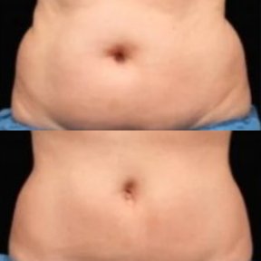 Результати до і після кріоліполізу (кулскалптинг) живота в Alpha Beauty Hannover