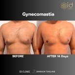 Gynecomastia surgery before and after results at ID Clinic Bangkok – flatter chest in 14 days