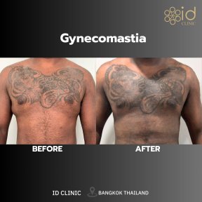 Gynecomastia surgery before and after results at ID Clinic Bangkok, improved chest contour