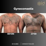 Gynecomastia surgery before and after results at ID Clinic Bangkok, improved chest contour