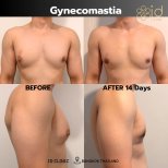 Gynecomastia surgery before and after results at ID Clinic Bangkok, flatter chest in 14 days