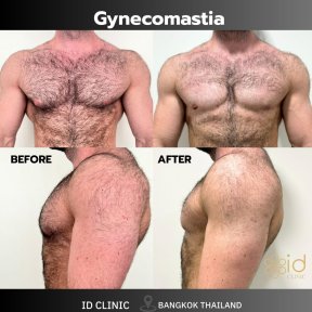 Before and after gynecomastia surgery results at ID Clinic Bangkok, male chest contouring