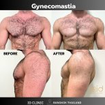 Before and after gynecomastia surgery results at ID Clinic Bangkok, male chest contouring