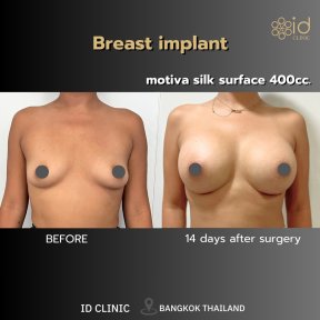 Before and after breast augmentation with Motiva implants at ID Clinic Bangkok, 14-day result