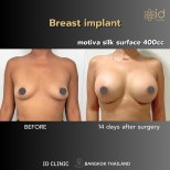Before and after breast augmentation with Motiva implants at ID Clinic Bangkok, 14-day result