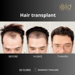 Before and after hair transplant results at ID Clinic Bangkok, visible hairline improvement