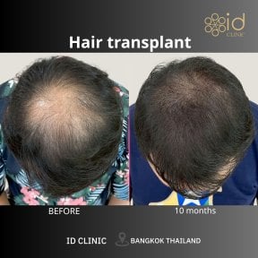 Before and after hair transplant results at ID Clinic Bangkok, visible hair density improvement