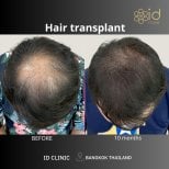 Before and after hair transplant results at ID Clinic Bangkok, visible hair density improvement