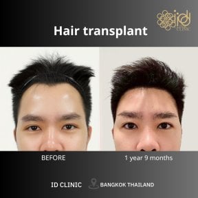 Before and after hair transplant results at ID Clinic Bangkok, fuller hairline after 1 year 9 months