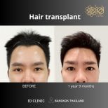 Before and after hair transplant results at ID Clinic Bangkok, fuller hairline after 1 year 9 months