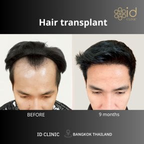 Before and after hair transplant result at ID Clinic Bangkok, fuller hairline after 9 months