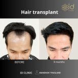Before and after hair transplant result at ID Clinic Bangkok, fuller hairline after 9 months