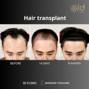 Before and after hair transplant results at ID Clinic Bangkok – restored hairline in 8 months