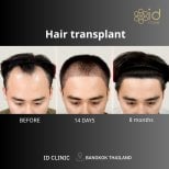Before and after hair transplant results at ID Clinic Bangkok – restored hairline in 8 months