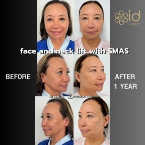 Before and after facelift and neck lift with SMAS at ID Clinic Bangkok, 1 year result