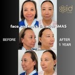 Before and after facelift and neck lift with SMAS at ID Clinic Bangkok, 1 year result